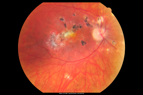 Multifocal Choroiditis and Subretinal Fibrosis - 32 yo Female Old Macular Scar OD
32-year-old woman vision loss in the right eye associated with macular scarring and multifocal choroiditis in 1999 with new vision loss in left eye:  OD 20/400, OS 20/50. 
Keywords: Multifocal Choroiditis;Macular Scar;Fibrosis;Uveitis
