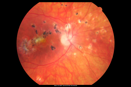Multifocal Choroiditis and Subretinal Fibrosis - 32 yo Female Multifocal and macular scar OD
32-year-old woman vision loss in the right eye associated with macular scarring and multifocal choroiditis in 1999 with new vision loss in left eye:  OD 20/400, OS 20/50. 
Keywords: Multifocal Choroiditis;Macular Scar;Fibrosis;Uveitis
