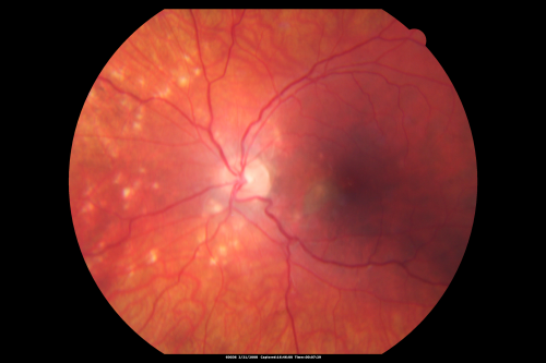 Multifocal Choroiditis and Subretinal Fibrosis - 32 yo Female Multifocal Scars - PIC Like
32-year-old woman vision loss in the right eye associated with macular scarring and multifocal choroiditis in 1999 with new vision loss in left eye:  OD 20/400, OS 20/50. 
Keywords: Multifocal Choroiditis; Macular Scar; Fibrosis; Uveitis