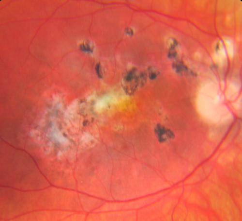 Multifocal Choroiditis and Subretinal Fibrosis - 32 yo Female Old Scar OD
32-year-old woman vision loss in the right eye associated with macular scarring and multifocal choroiditis in 1999 with new vision loss in left eye:  OD 20/400, OS 20/50. 
Keywords: Multifocal Choroiditis; Macular Scar; Fibrosis; Uveitis