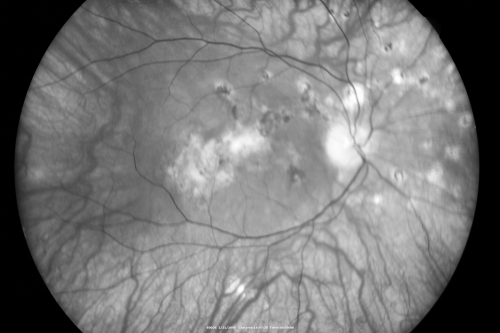 Multifocal Choroiditis and Subretinal Fibrosis - 32 yo Female Old Scar OD
32-year-old woman vision loss in the right eye associated with macular scarring and multifocal choroiditis in 1999 with new vision loss in left eye:  OD 20/400, OS 20/50. 
Keywords: Multifocal Choroiditis;Macular Scar;Fibrosis;Uveitis