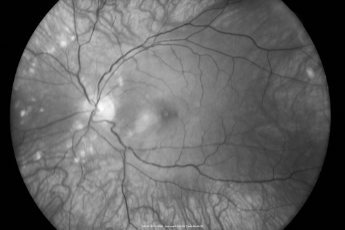 Multifocal Choroiditis and Subretinal Fibrosis - 32 yo Female New Lesion OS
32-year-old woman vision loss in the right eye associated with macular scarring and multifocal choroiditis in 1999 with new vision loss in left eye:  OD 20/400, OS 20/50. 
Keywords: Multifocal Choroiditis;Macular Scar;Fibrosis;Uveitis