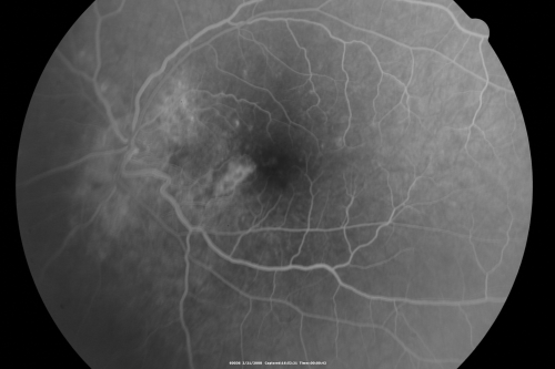 Multifocal Choroiditis and Subretinal Fibrosis - 32 yo Female New Lesion OS
32-year-old woman vision loss in the right eye associated with macular scarring and multifocal choroiditis in 1999 with new vision loss in left eye:  OD 20/400, OS 20/50. 
Keywords: Multifocal Choroiditis;Macular Scar;Fibrosis;Uveitis