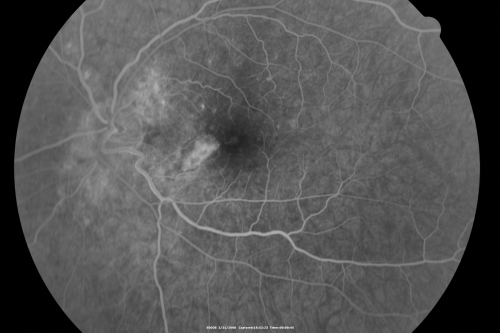 Multifocal Choroiditis and Subretinal Fibrosis - 32 yo Female New Lesion OS
32-year-old woman vision loss in the right eye associated with macular scarring and multifocal choroiditis in 1999 with new vision loss in left eye:  OD 20/400, OS 20/50. 
Keywords: Multifocal Choroiditis;Macular Scar;Fibrosis;Uveitis