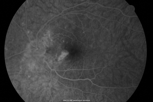 Multifocal Choroiditis and Subretinal Fibrosis - 32 yo Female New Lesion OS
32-year-old woman vision loss in the right eye associated with macular scarring and multifocal choroiditis in 1999 with new vision loss in left eye:  OD 20/400, OS 20/50. 
Keywords: Multifocal Choroiditis;Macular Scar;Fibrosis;Uveitis