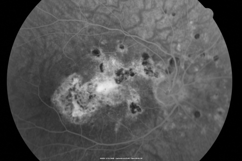 Multifocal Choroiditis and Subretinal Fibrosis - 32 yo Female Old Scar OD
32-year-old woman vision loss in the right eye associated with macular scarring and multifocal choroiditis in 1999 with new vision loss in left eye:  OD 20/400, OS 20/50. 
Palabras clave: Multifocal Choroiditis;Macular Scar;Fibrosis;Uveitis