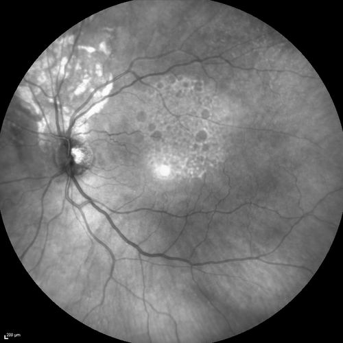 Retinal Pigment Epithleium Dysgenesis 
