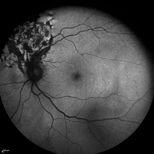 Retinal Pigment Epithleium Dysgenesis - Autofluorescence
