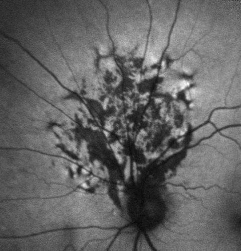 Retinal Pigment Epithleium Dysgenesis - Autofluorescence
