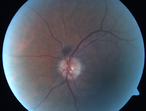Microaneursyms and Macular Edema Not Diabetic
85 year old man has been tested about 2-3 times and is always negative for diabetes
