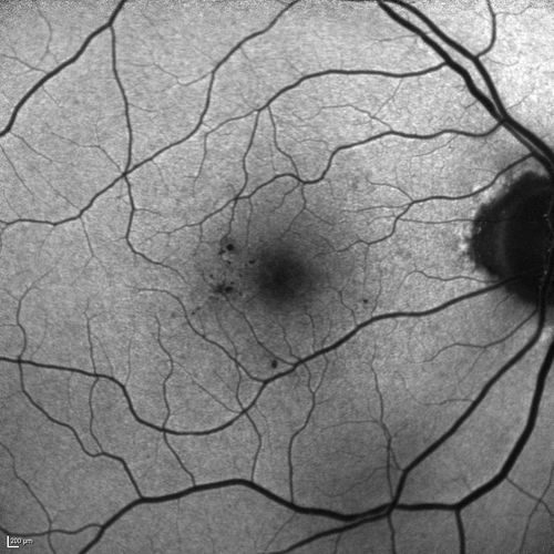 Microaneursyms and Macular Edema Not Diabetic
85 year old man has been tested about 2-3 times and is always negative for diabetes
