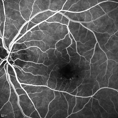Microaneursyms and Macular Edema Not Diabetic
85 year old man has been tested about 2-3 times and is always negative for diabetes

