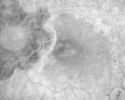 Acute Zonal Occult Outer Retinopathy with Severe Peripheral Vision Loss Left Eye 
 58-year-old man developed a peripheral vision problem about 25 years ago.   OD 20/30, OS 20/40.
Keywords: azoor;bone spicules;retinitis pigmentosa;rp;pseudo
