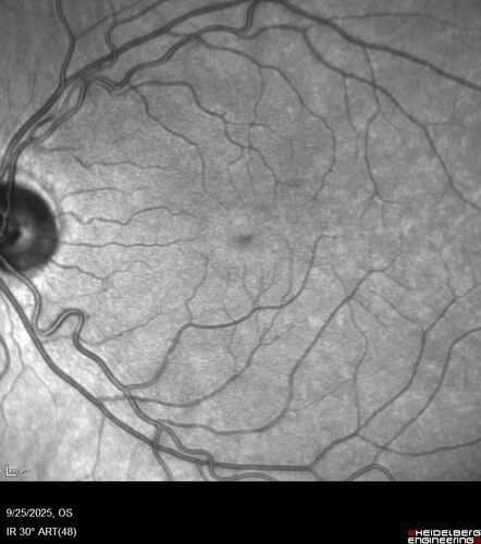 27 year old with migraine - normal imaging
