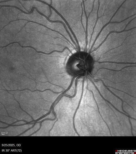 27 year old with migraine - normal imaging
