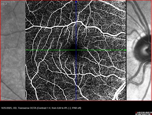 27 year old with migraine - normal imaging
