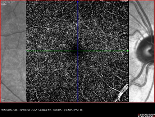 27 year old with migraine - normal imaging
