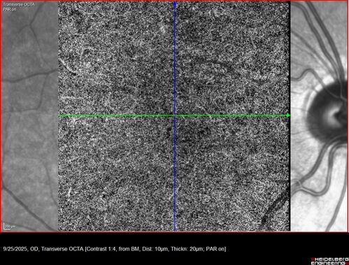 27 year old with migraine - normal imaging
