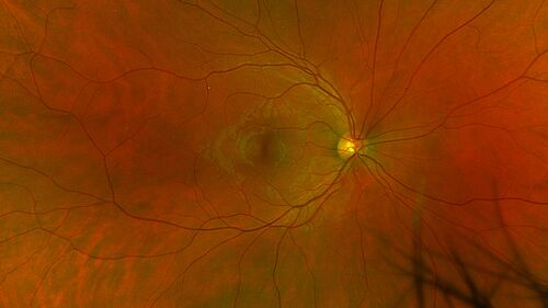 Small choroidal melanoma
28 year old man  Serial images suggested that the lesion is growing
OD: sc20/16 
OS: sc20/40+2 
IOP: TP: OD:19 OS:16 
