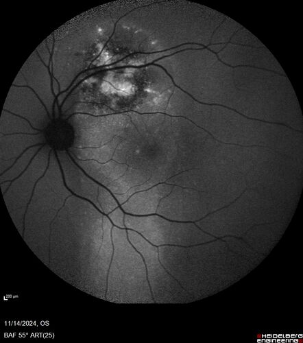 Small choroidal melanoma
28 year old man  Serial images suggested that the lesion is growing
OD: sc20/16 
OS: sc20/40+2 
IOP: TP: OD:19 OS:16 
