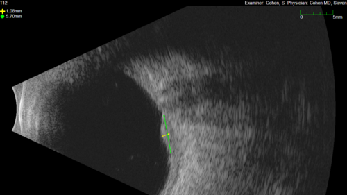 Small choroidal melanoma
28 year old man  Serial images suggested that the lesion is growing
OD: sc20/16 
OS: sc20/40+2 
IOP: TP: OD:19 OS:16 
