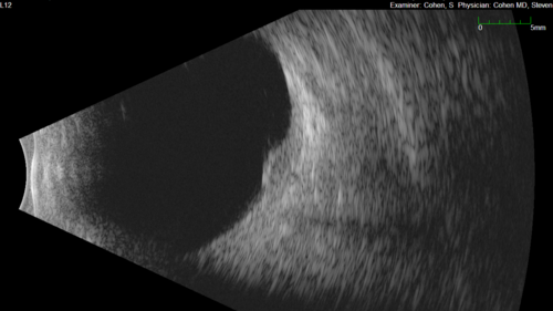 Small choroidal melanoma
28 year old man  Serial images suggested that the lesion is growing
OD: sc20/16 
OS: sc20/40+2 
IOP: TP: OD:19 OS:16 
