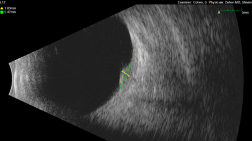 Small choroidal melanoma
28 year old man  Serial images suggested that the lesion is growing
OD: sc20/16 
OS: sc20/40+2 
IOP: TP: OD:19 OS:16 
