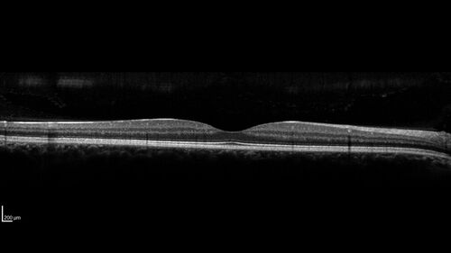 Small choroidal melanoma
28 year old man  Serial images suggested that the lesion is growing
OD: sc20/16 
OS: sc20/40+2 
IOP: TP: OD:19 OS:16 
