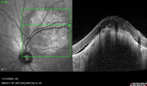 Small choroidal melanoma
28 year old man  Serial images suggested that the lesion is growing
OD: sc20/16 
OS: sc20/40+2 
IOP: TP: OD:19 OS:16 
