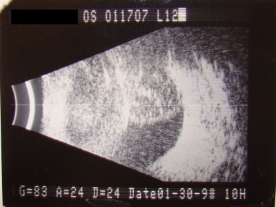 Melanoma - Large Ciliary Body B Scan Ultrasound
