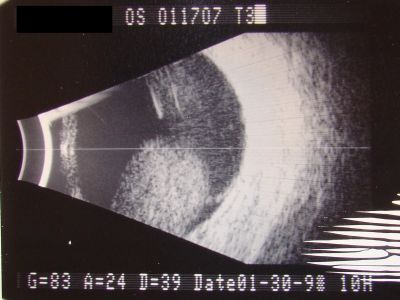Melanoma - Large Ciliary Body B-Scan ultrasound shows tumore filling much of the eye
