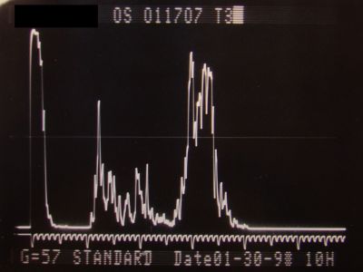 Melanoma - Large Ciliary Body A scan shows medium to low internal reflectivity
