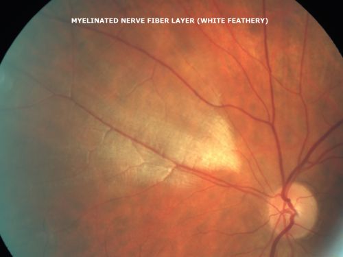 Myelinated Nerve Fiber Layer
69-year-old woman  OD is 20/30, OS is 20/40. 
