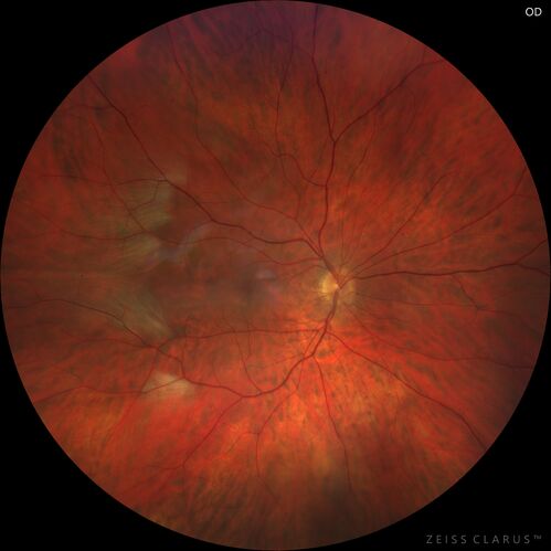 Myelinated Nerve Fiber Layer - Peripheral
43 year old man with floaters
