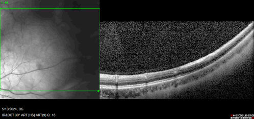 Myelinated Nerve Fiber Layer - Peripheral
43 year old man with floaters
