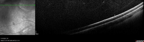 Myelinated Nerve Fiber Layer - Peripheral
43 year old man with floaters
