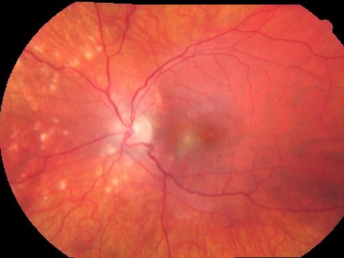 Multifocal Choroiditis and Subretinal Fibrosis - 32 yo Female Montage Initial Visit
32-year-old woman vision loss in the right eye associated with macular scarring and multifocal choroiditis in 1999 with new vision loss in left eye:  OD 20/400, OS 20/50. 

2 months post-rx with posterior subtenons kenalog and intravitreal avastin - va os 20/30 and lesion has retracted and organized.  It never subsequently grew over 2 years follow-up
Schlüsselwörter: Multifocal Choroiditis;Macular Scar;Fibrosis;Uveitis