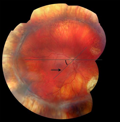 Retinal Torsion after Macula Off Retinal Detachment Repair with Inferior PVR
37 year old with torsion of the retina after macula off retinal detachment repair with inferior PVR and membranes dragging the fovea inferiorly.
