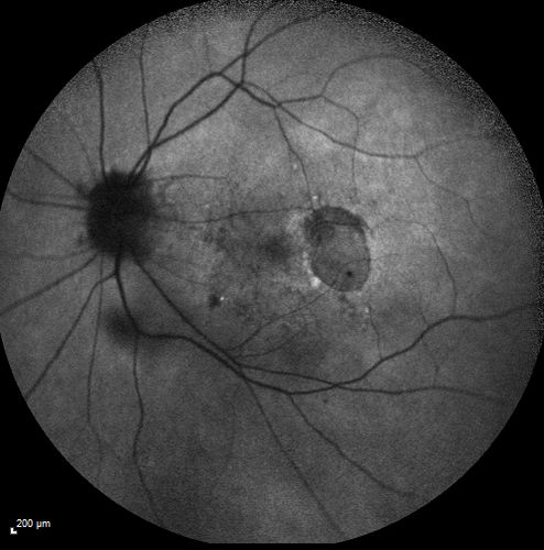 Myopic Traction Maculopathy - Long Term Follow-up
88-92 year old woman with about 20/40 vision and myopic tractional maculopathy.  Her vision fluctuates a little.  The serial OCT's show no progression.
