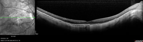 Myopic Traction Maculopathy - Long Term Follow-up
88-92 year old woman with about 20/40 vision and myopic tractional maculopathy.  Her vision fluctuates a little.  The serial OCT's show no progression.
