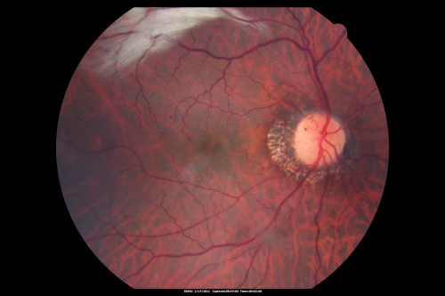 Myelinated Nerve Fiber Layer Right Eye (white area)
62-year-old man myelinated nerve fiber layer in the right eye.  OD 20/25,  OS 20/30. 
