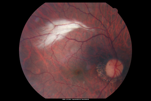 Myelinated Nerve Fiber Layer Right Eye (white area)
62-year-old man myelinated nerve fiber layer in the right eye.  OD 20/25,  OS 20/30. 
