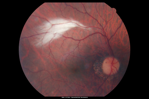 Myelinated Nerve Fiber Layer Right Eye (white area)
62-year-old man myelinated nerve fiber layer in the right eye.  OD 20/25,  OS 20/30. 
