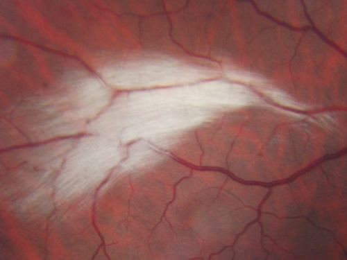Myelinated Nerve Fiber Layer Right Eye (white area)
62-year-old man myelinated nerve fiber layer in the right eye.  OD 20/25,  OS 20/30. 
