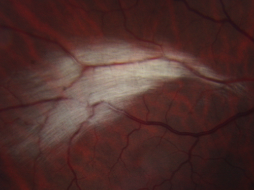 Myelinated Nerve Fiber Layer Right Eye (white area)
62-year-old man myelinated nerve fiber layer in the right eye.  OD 20/25,  OS 20/30. 
