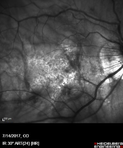 Rapid macular atrophy with anti-VEGF therapy for myopic CNVM
64 year old female with 20/32 vision and distortion in the left and better eye.  She was treated with monthly lucentis and her vision declined to 20/100.  Medicine was stopped and she improved a little to 20/80.
