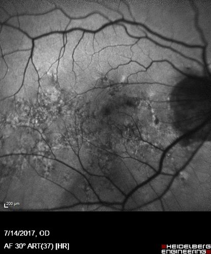 Rapid macular atrophy with anti-VEGF therapy for myopic CNVM
64 year old female with 20/32 vision and distortion in the left and better eye.  She was treated with monthly lucentis and her vision declined to 20/100.  Medicine was stopped and she improved a little to 20/80.
