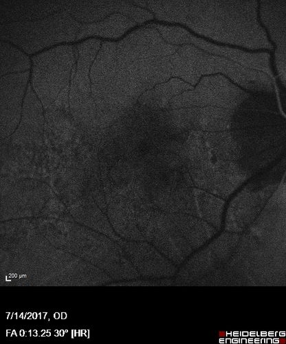 Rapid macular atrophy with anti-VEGF therapy for myopic CNVM
64 year old female with 20/32 vision and distortion in the left and better eye.  She was treated with monthly lucentis and her vision declined to 20/100.  Medicine was stopped and she improved a little to 20/80.
