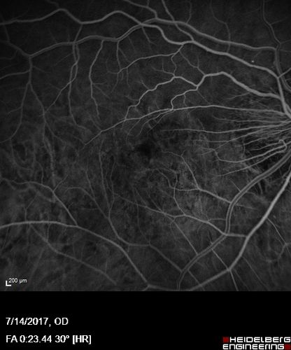 Rapid macular atrophy with anti-VEGF therapy for myopic CNVM
64 year old female with 20/32 vision and distortion in the left and better eye.  She was treated with monthly lucentis and her vision declined to 20/100.  Medicine was stopped and she improved a little to 20/80.
