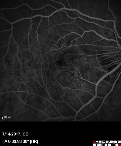 Rapid macular atrophy with anti-VEGF therapy for myopic CNVM
64 year old female with 20/32 vision and distortion in the left and better eye.  She was treated with monthly lucentis and her vision declined to 20/100.  Medicine was stopped and she improved a little to 20/80.
